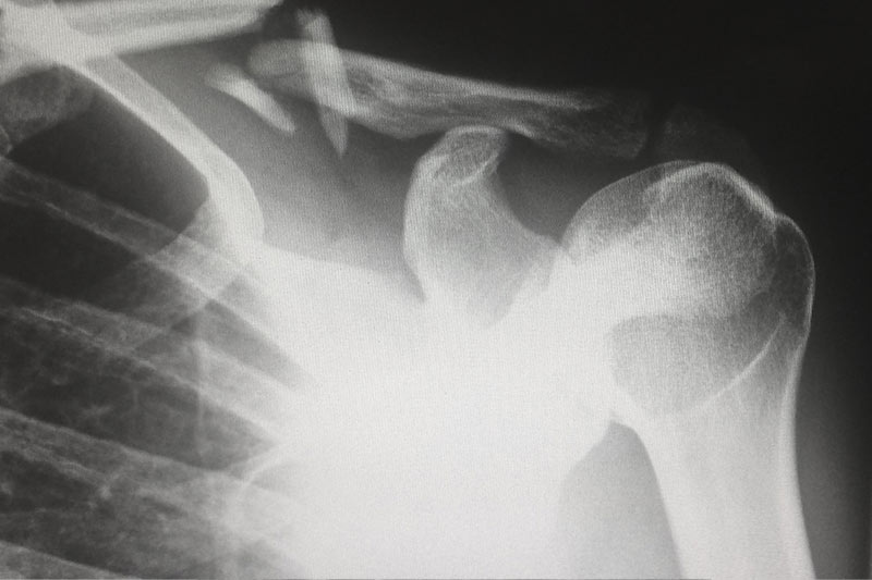 Scan of injured shoulder