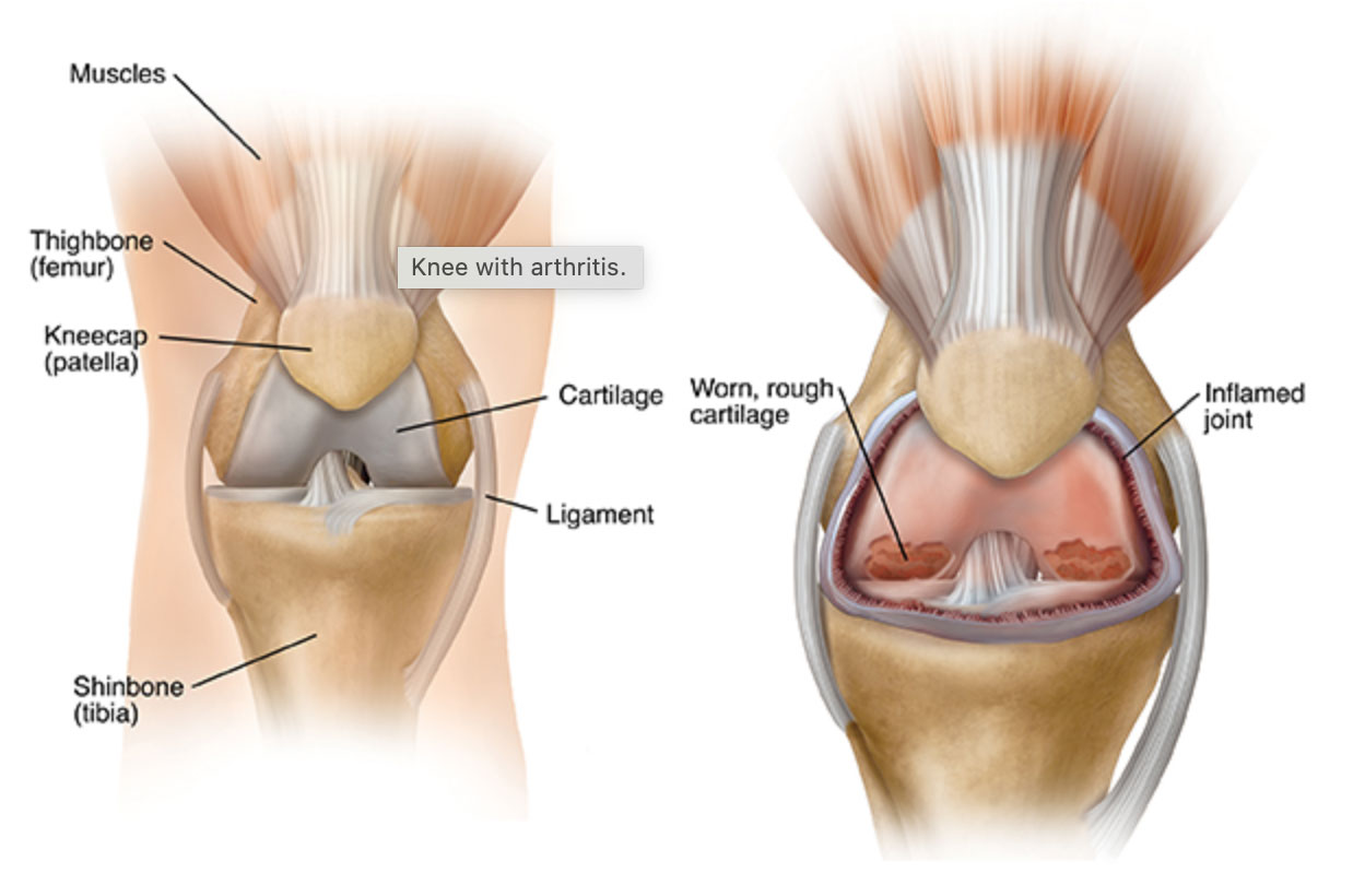 Knee replacement illustration